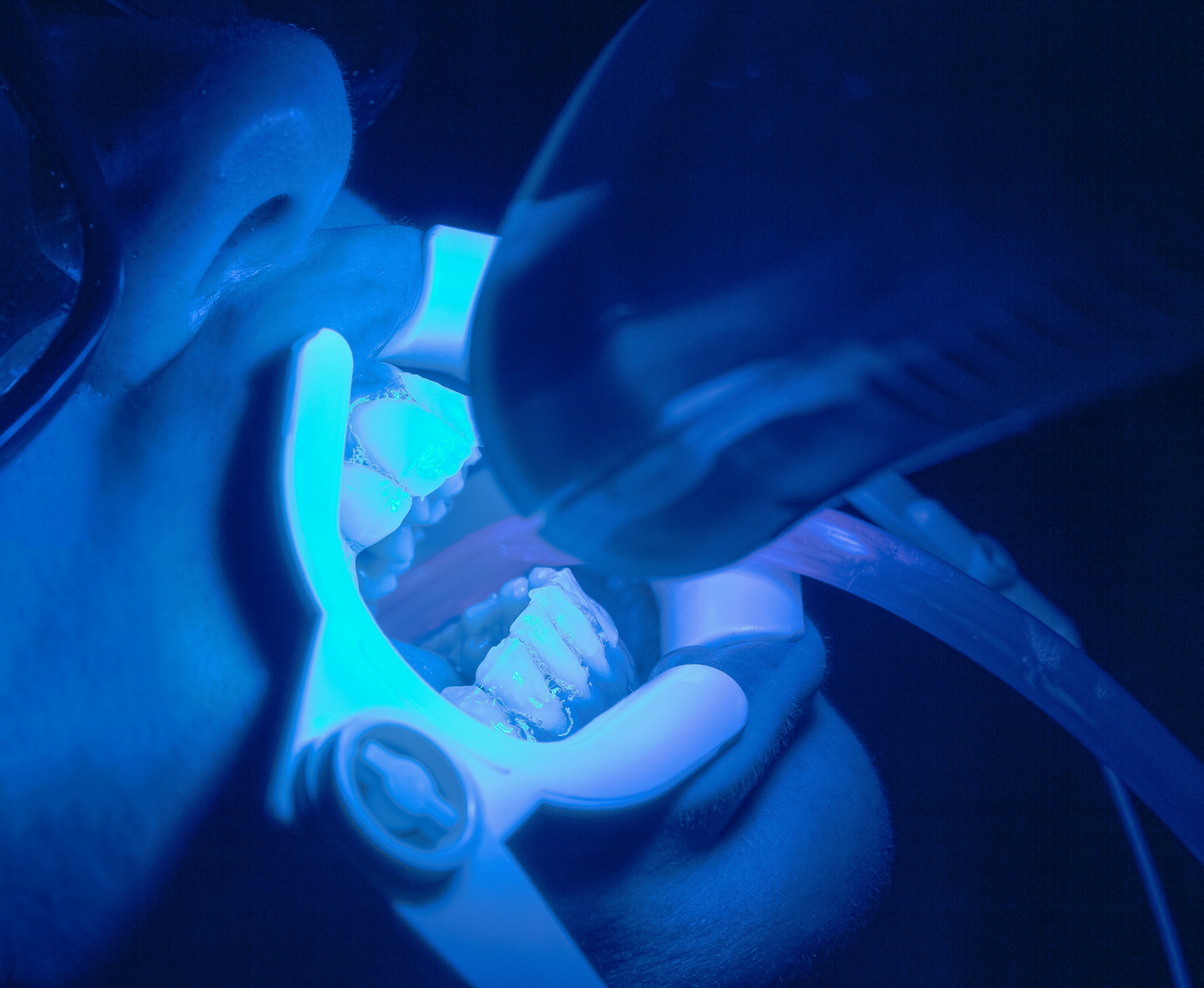 Blanqueamiento dental sonrisa perfecta resultado dientes blancos