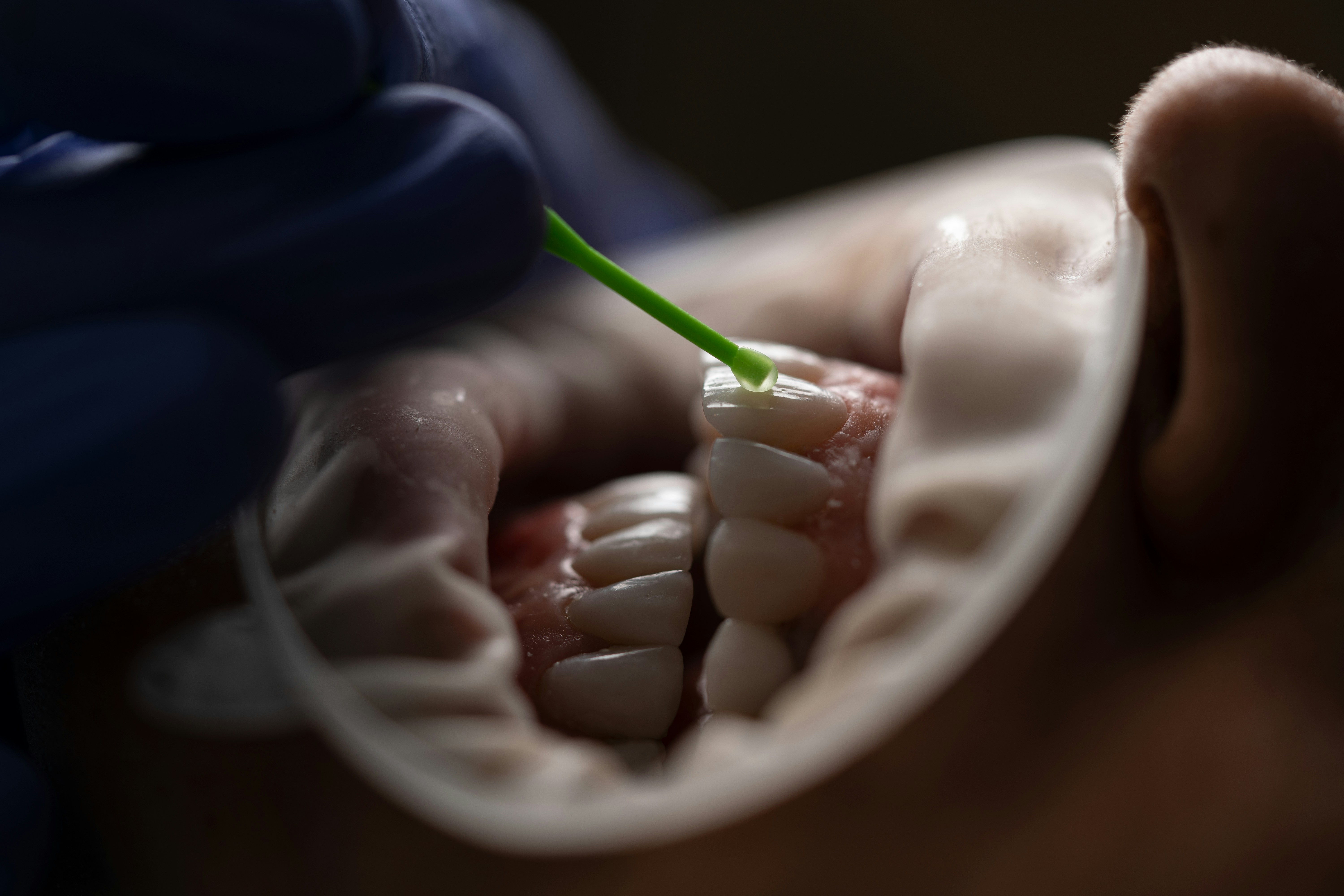 Encías sangran gingivitis periodoncia enfermedad periodontal tratamiento