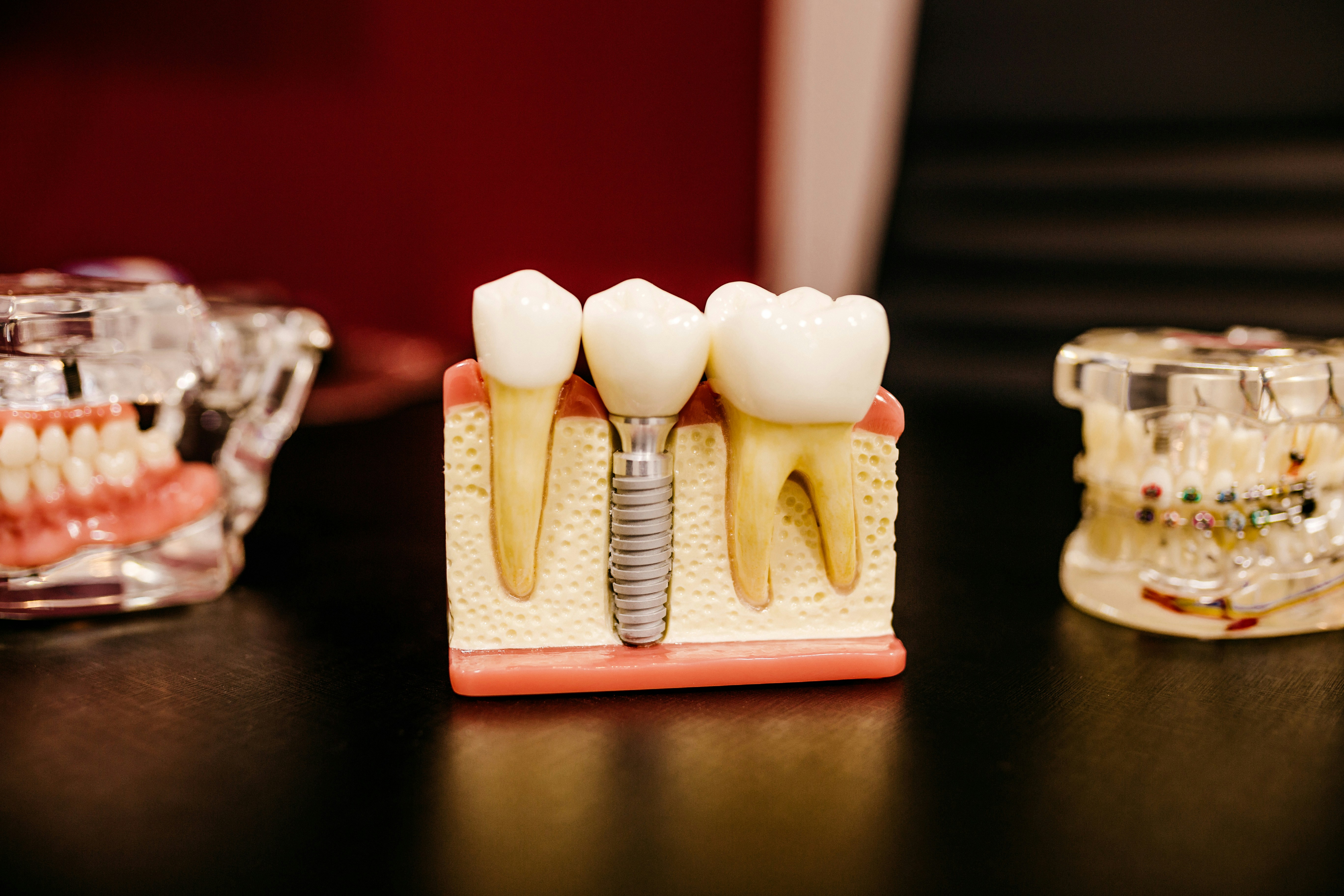 Implante dental sillón clínica tratamiento