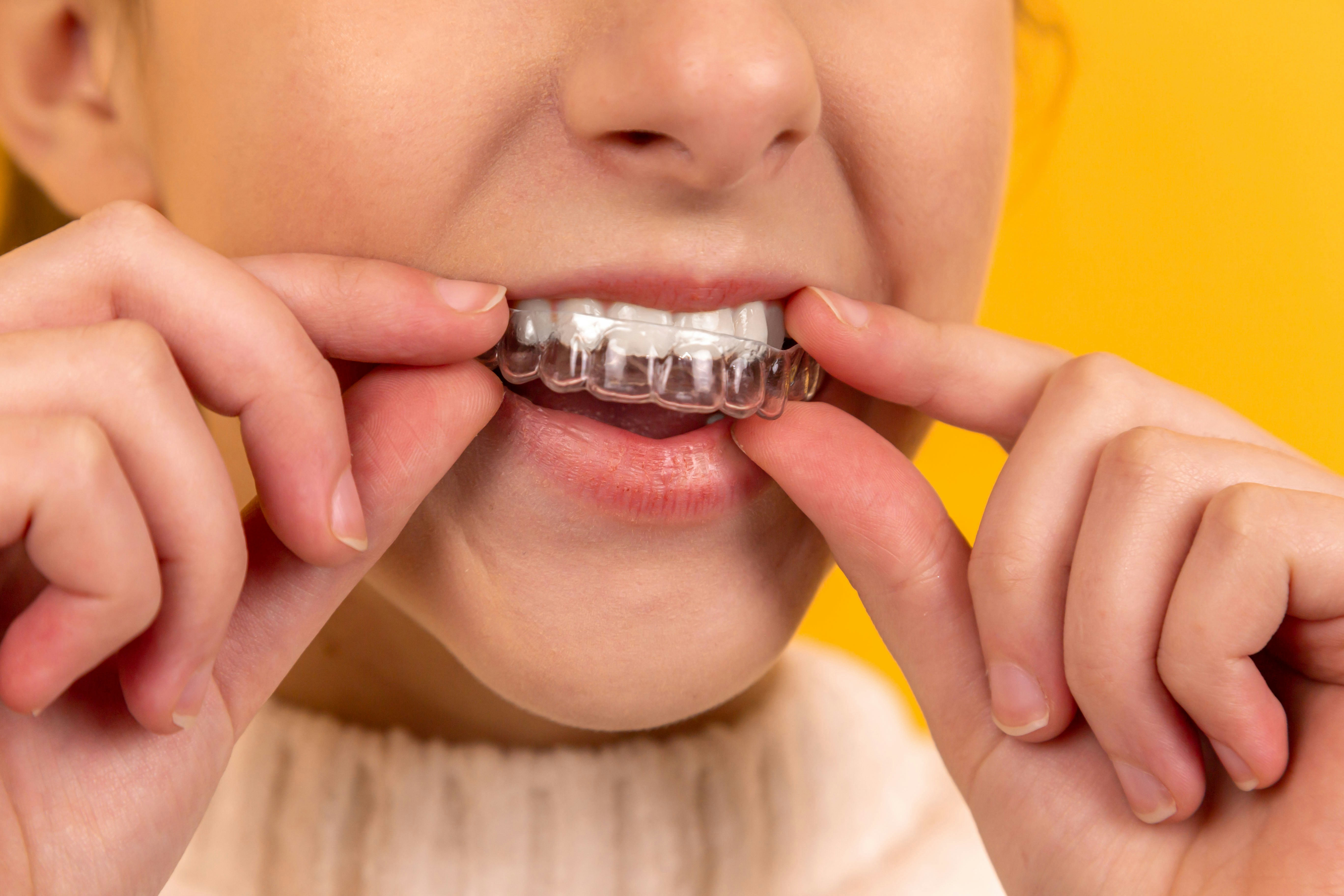 Ortodoncia invisible alineadores transparentes Invisalign brackets dientes